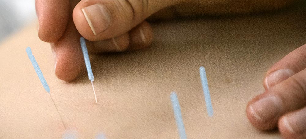 Cupping iglom kombinacija je cupping terapije i akupunkture. Akupunktura — terapija iglama, tradicionalna kineska medicina, stimulacija točaka, akupunkturna terapija