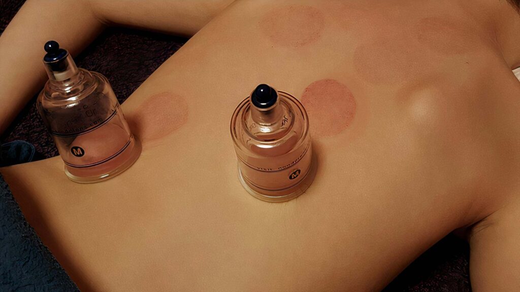 Pomični/masažni cupping: cupping masaža — masaža čašicama, vakuum masaža, terapijska masaža, masaža uljima
