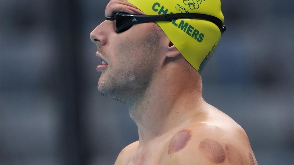 Sportski cupping: izdržljivost sportaša — snaga sportaša, fizička izdržljivost, sportska priprema, kondicijski oporavak