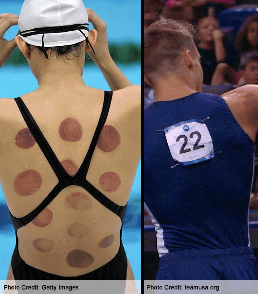 Sportski cupping - cupping terapija — hidžama, vakuum terapija, terapija čašicama, cupping masaža